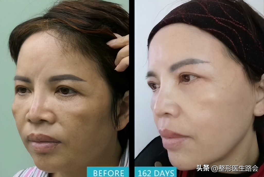 上海九院膨体填充太阳穴费用多少,膨体丰太阳穴视频全过程