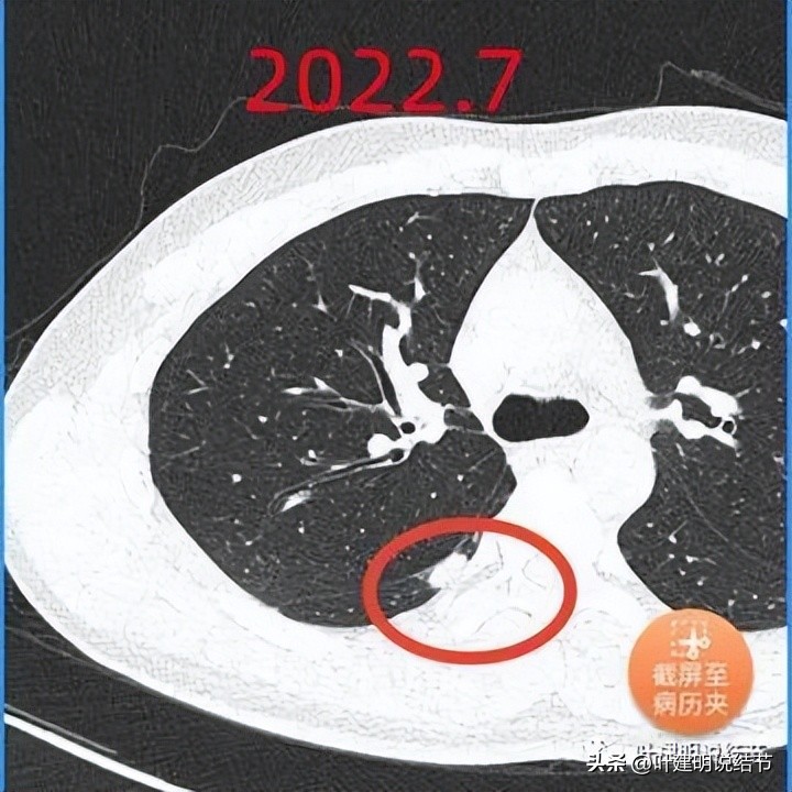 肺部结节医生建议抗炎后复查,放射科医生查出肺结节