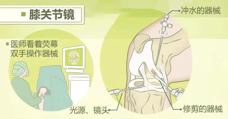 关节镜可以找到膝盖疼的原因吗,膝盖关节镜副作用