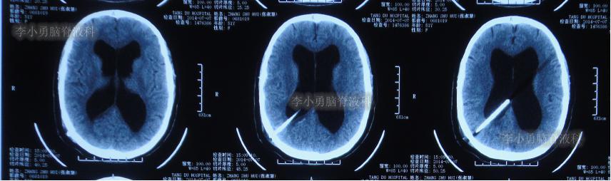 脑积水手术后4天还呕吐怎么回事,脑积水分流术后一直腹部疼痛
