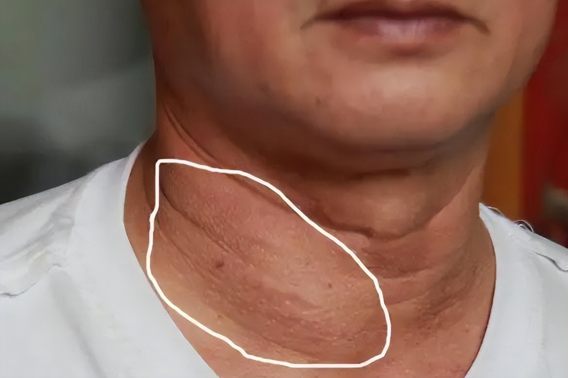 脖子里有结节是良性还是恶性,脖子上有结节吃什么药治疗