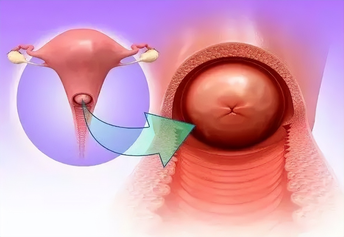 阴道炎到宫颈炎的演变及诊治策略