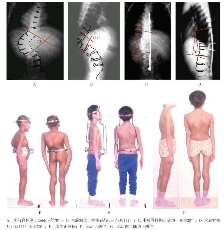 骨科基础：脊柱后侧凸截骨术