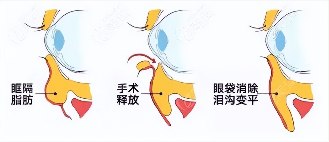 黑眼圈眼袋泪沟重怎么遮瑕,眼霜推荐去黑眼圈眼袋泪沟