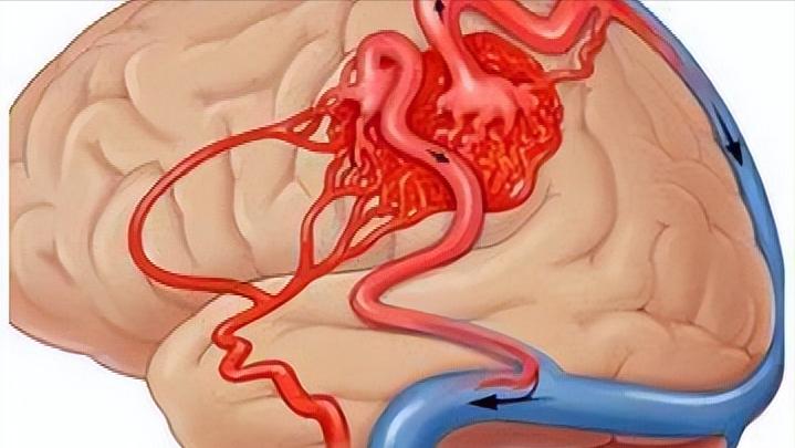 面神经麻痹后遗症的最佳治疗方法,面神经麻痹面部有麻木感觉吗