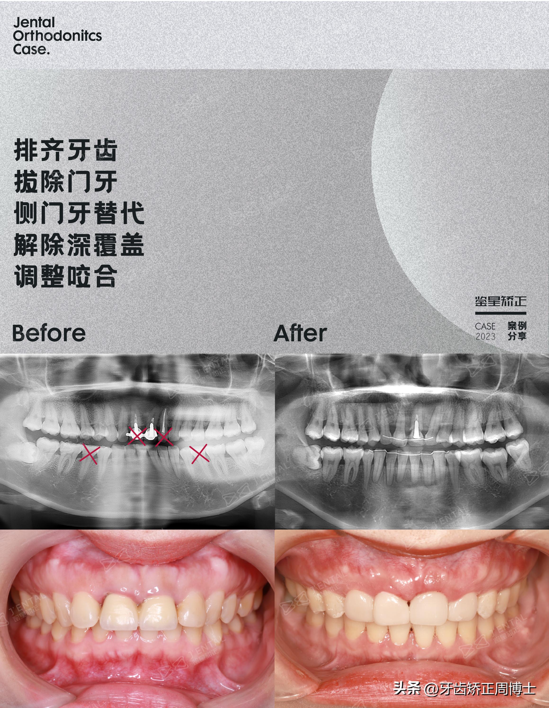骨性前突下巴后缩可以矫正吗,上颌骨前突下巴后缩如何矫正