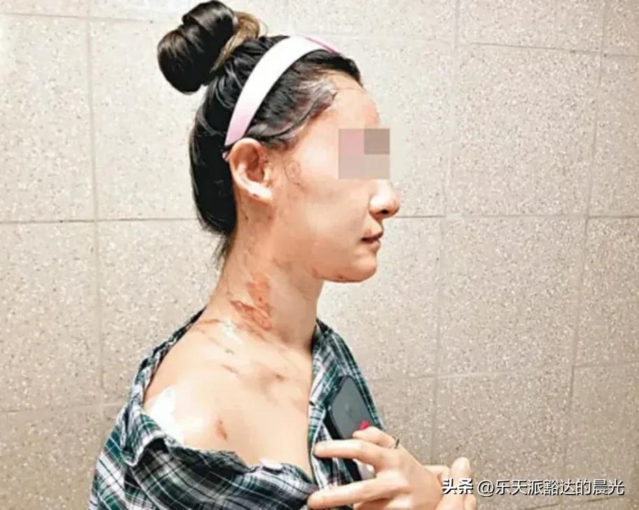 香港女子遭怪妇滚水兜头淋，女子脸留疤痛入心，造成二级烫伤
