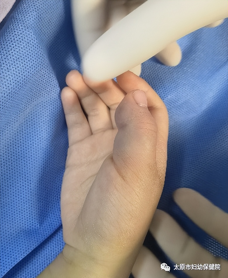 西安哪个医院治静脉畸形比较好,沈阳治疗静脉畸形