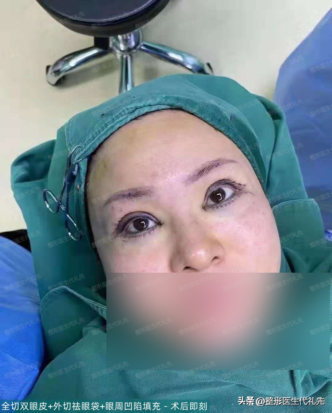 55岁女人割双眼皮之后的视频,40多岁女人做完双眼皮的视频