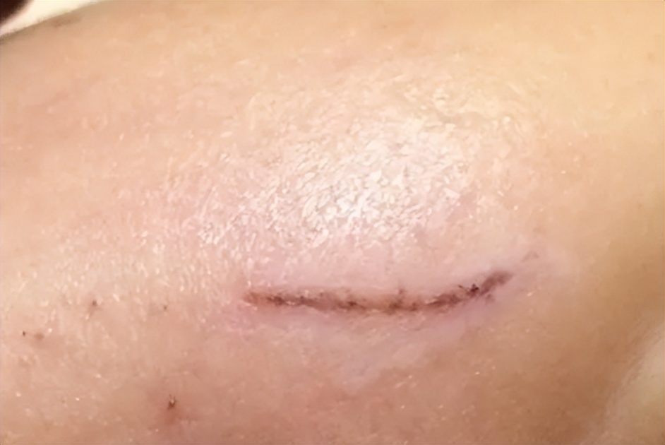 疤痕膏哪种效果最好,效果好的疤痕膏有哪些