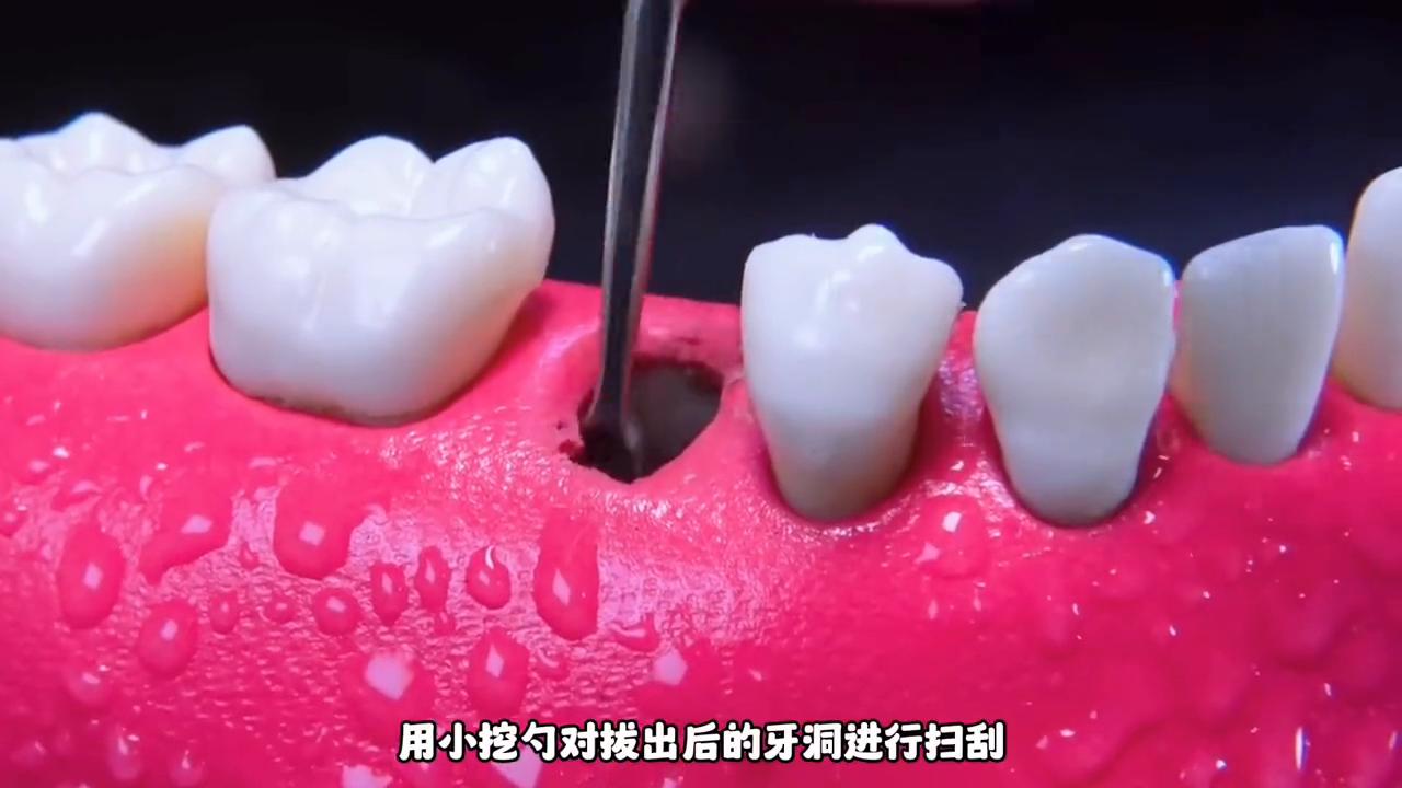 大牙劈裂到种植牙全过程,沉浸式牙齿根管治疗