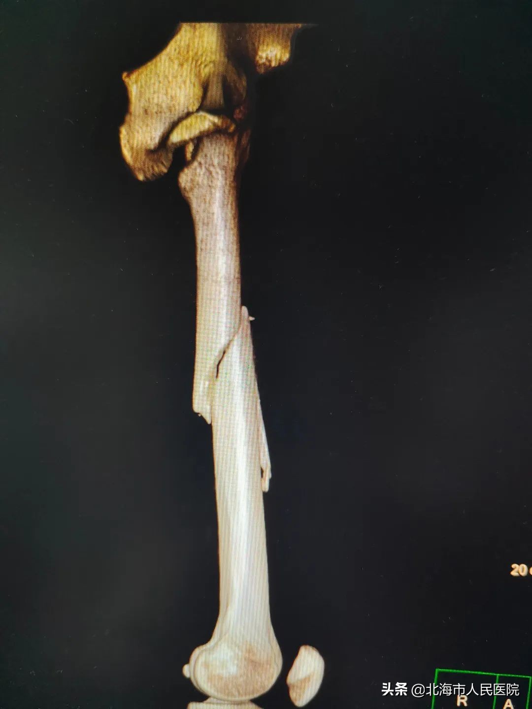 男子足球撞门柱,男子踢球被断球摔倒骨折