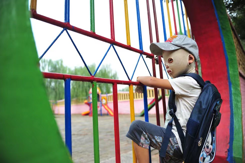 小孩子脸被火烧伤戴着面具,因烧伤带面具的山西小男孩