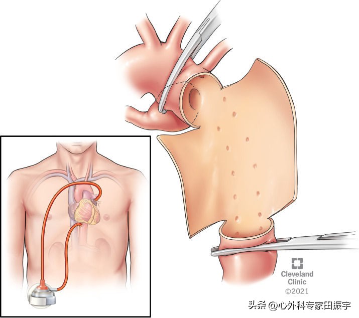 Kommerell憩室和迷走型锁骨下动脉修复术