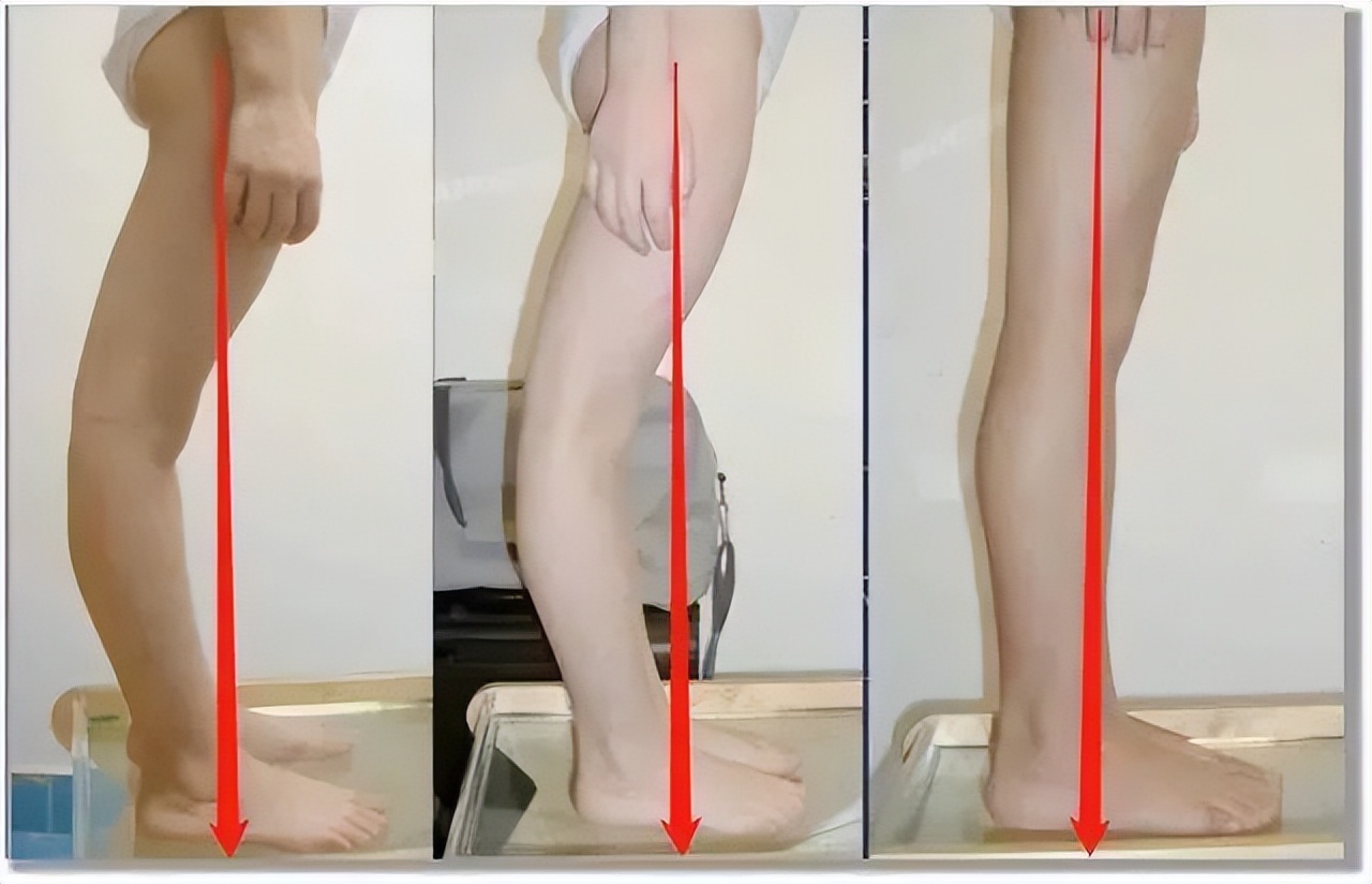 瘦腿必练|“膝超伸”一招鲜矫正！