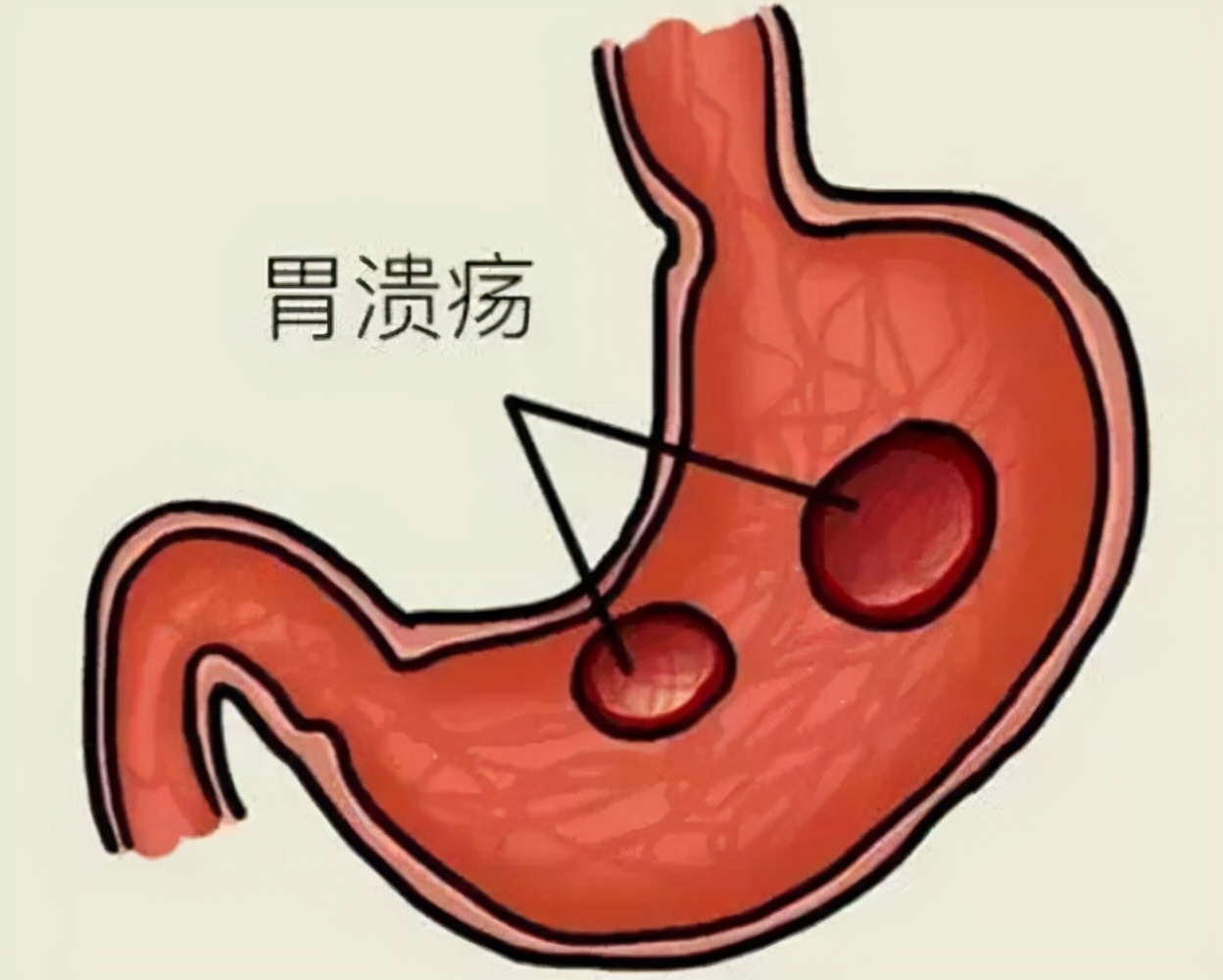 胃溃疡做病理检查是不是很严重,胃溃疡病理结果正常就没事了吗