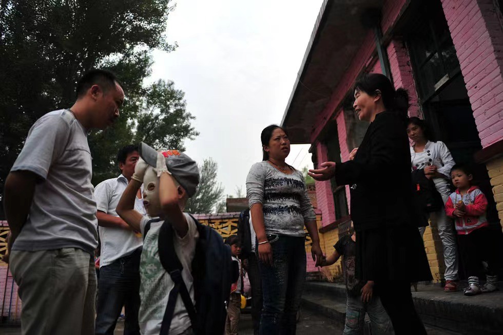 小孩被火烧伤戴面具,面具娃娃烧伤