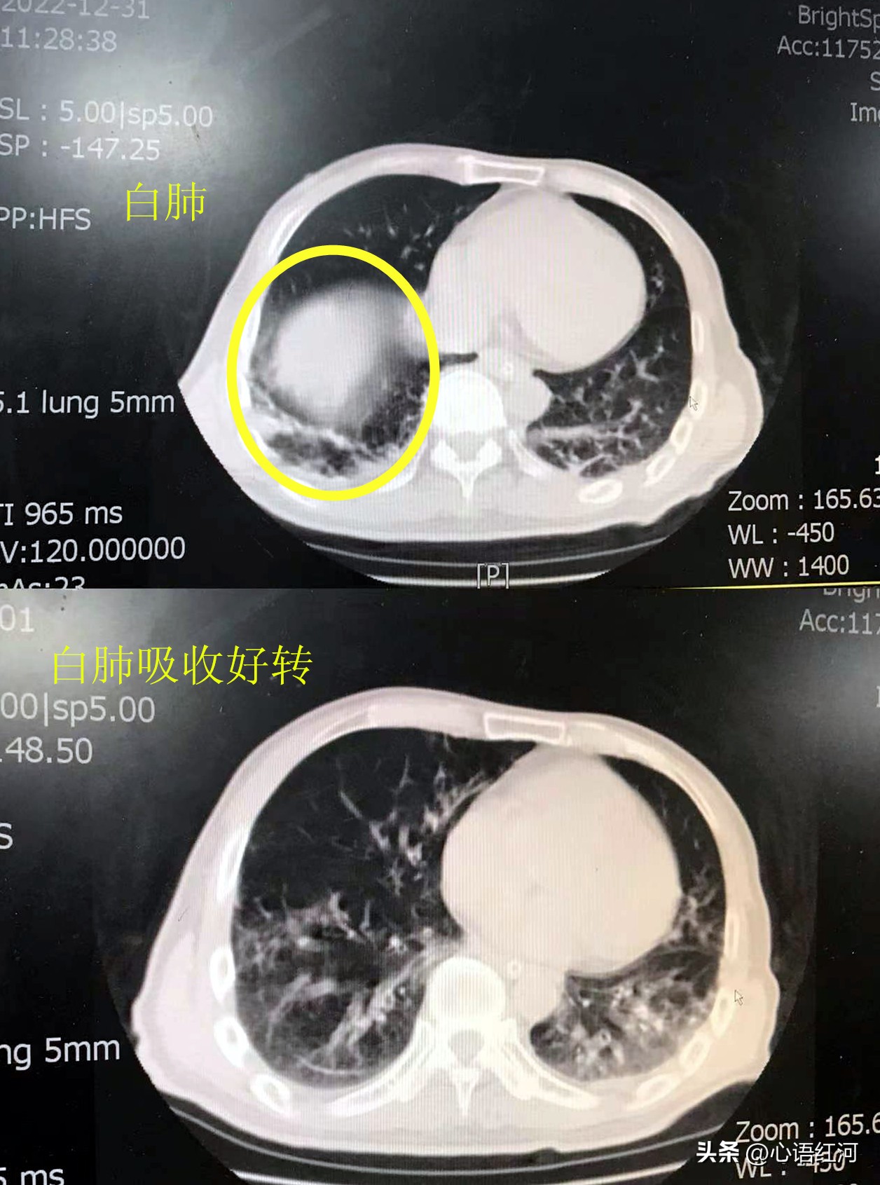 年轻人得了新冠发高烧怎么办,80多岁老人新冠六天了反复发烧