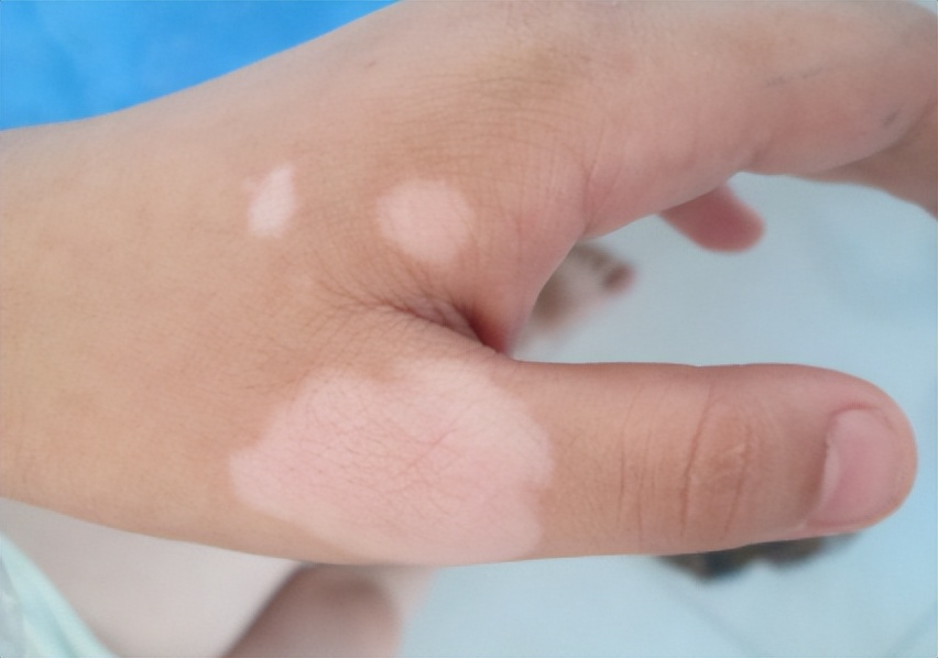 手部白斑治疗患者案例,手部白斑该咋诊疗呢