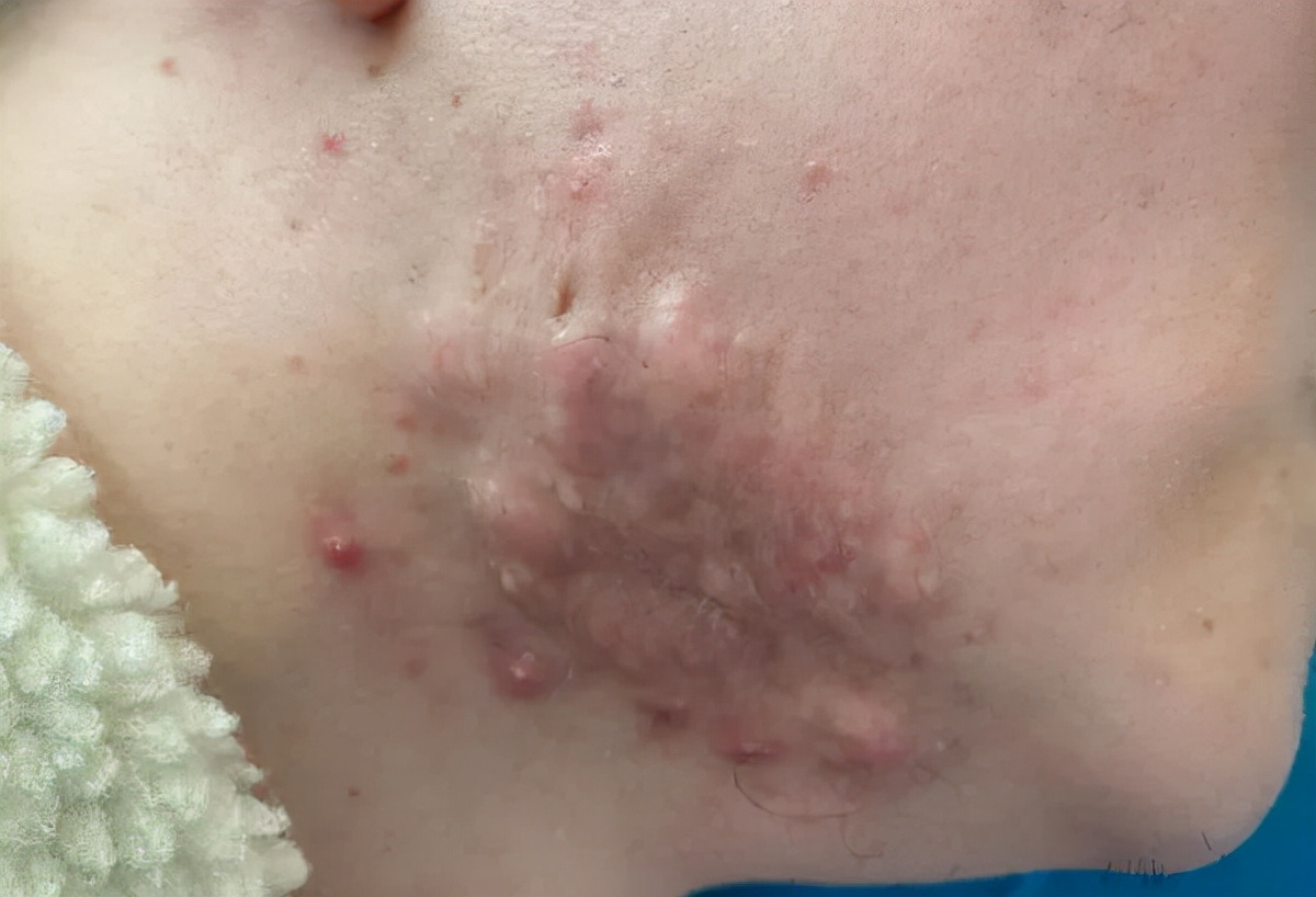 疮疤上有白痘痘,痘痘引起的瘢痕疙瘩