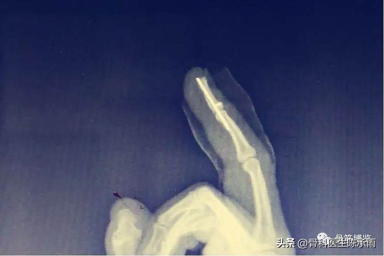 手指出现锤状畸形不要太紧张，看后知道伸肌腱止点断裂重建术