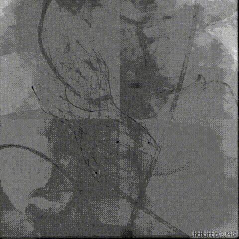 病例回顾与分享,腹膜后血肿介入治疗
