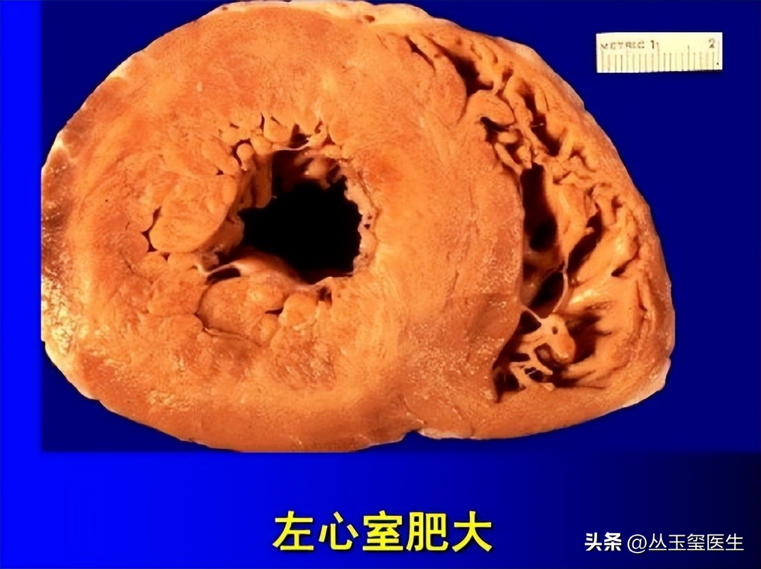 心血管疾病尿毒症,尿毒症最常见的心血管表现