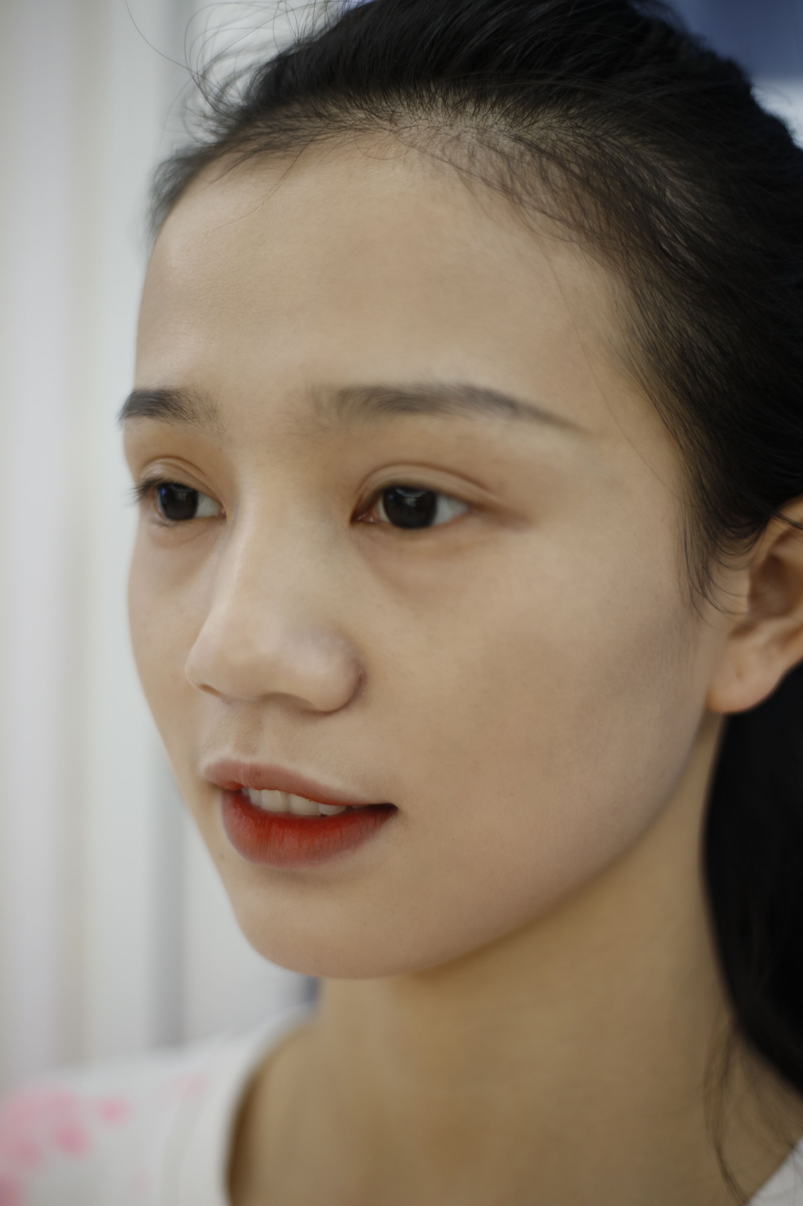 再漂亮的小姐姐也会被痘印困扰，治疗完后感叹激光治疗效果真不错