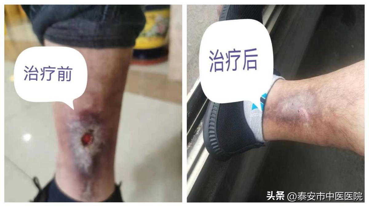 下肢静脉曲张引起的溃疡康复理疗,中医治疗下肢溃疡