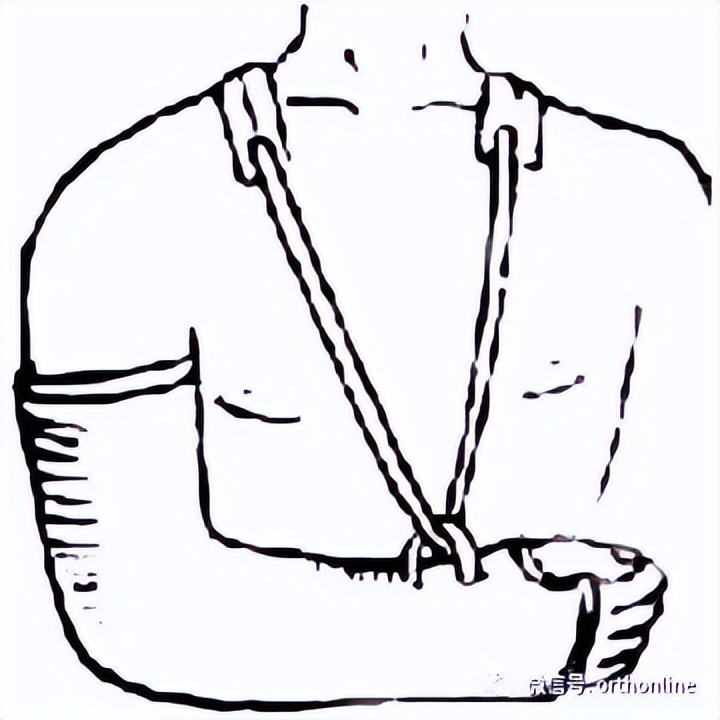 肱骨干骨折髓内钉手术记录,肱骨干骨折康复训练全套视频