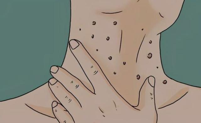 腋下脖子长小颗粒是怎么回事,脖子腋下长小肉粒可以用手揪掉吗