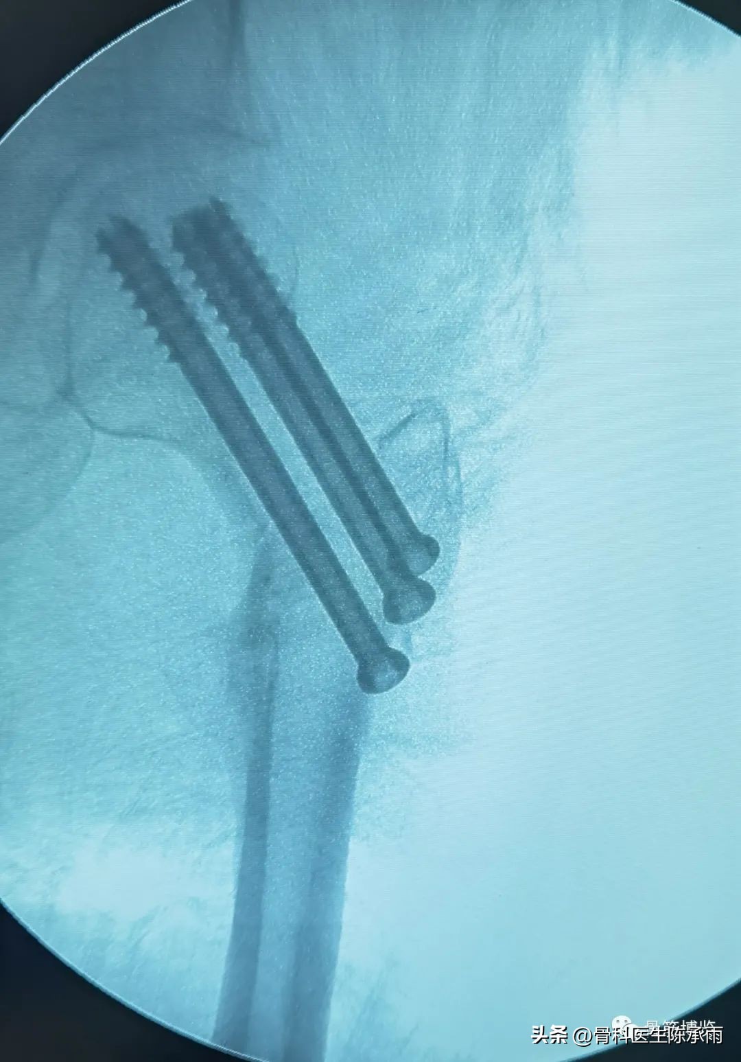 股骨颈闭合复位内固定术后护理,股骨颈骨折闭合复位的技巧