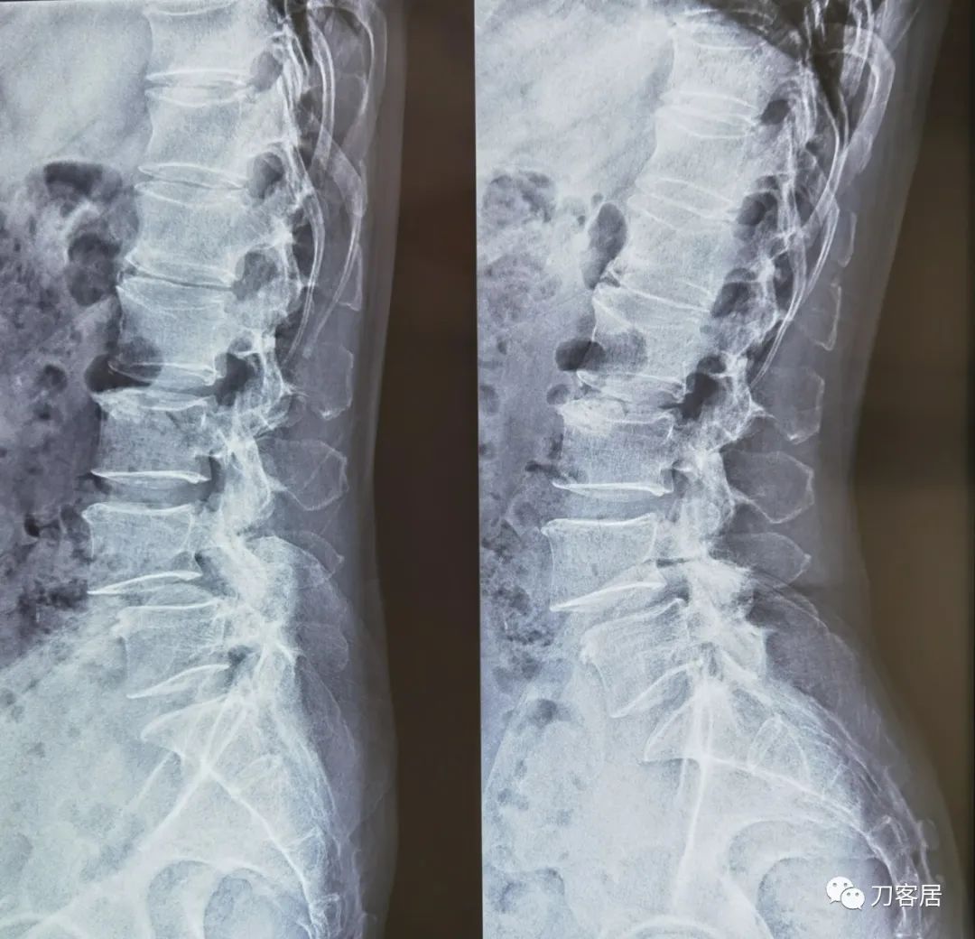 双小腿憋胀麻木,一般腰椎滑脱手术需要卧床多久