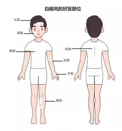 对称型白癜风由什么引起,白癜风白斑和普通白斑有什么区别