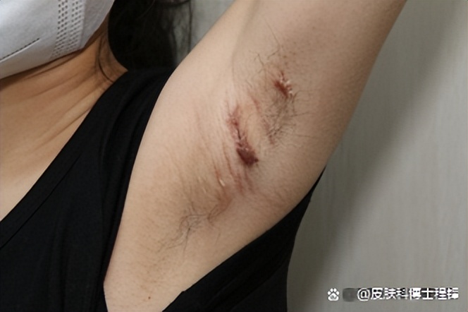 做完腋臭微创手术复发几率,腋臭手术后复发了怎么调理排毒