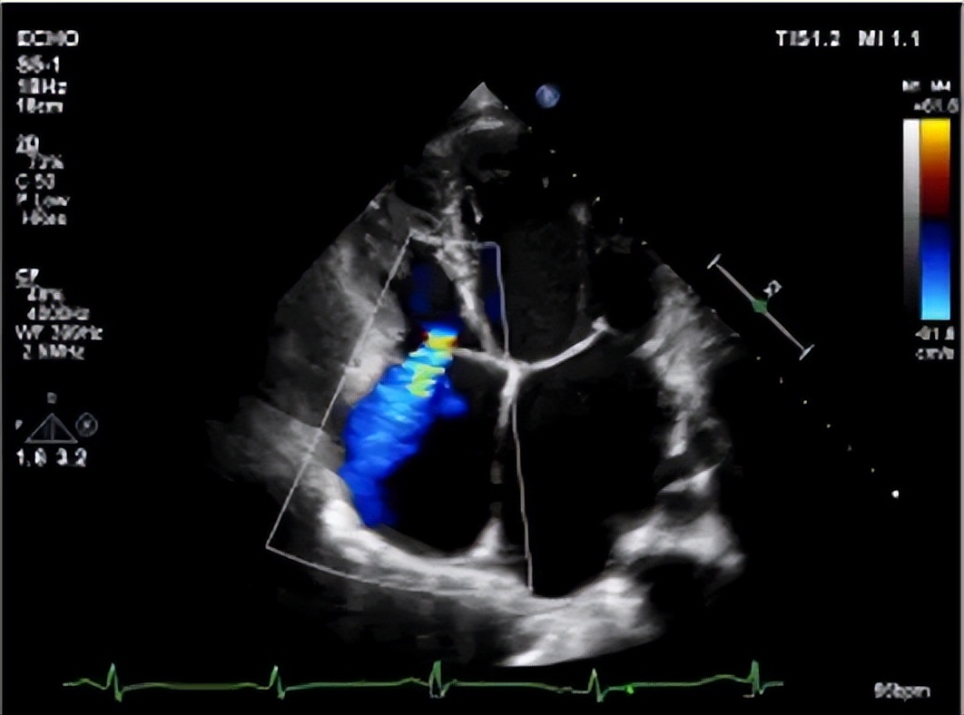 脑梗心梗深圳医院最好,深圳心肌梗塞医院