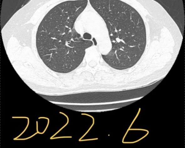 九个月内出现6mm磨玻璃结节,6mm的磨玻璃结节微浸润