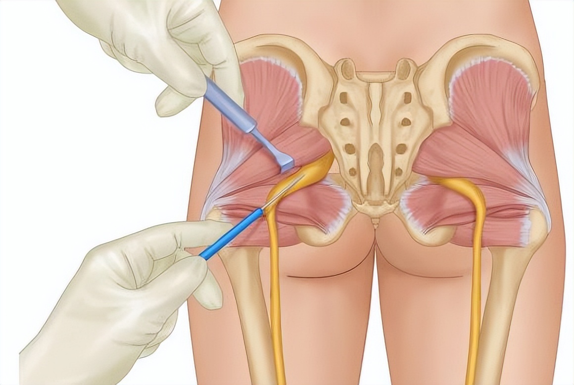梨状肌症是怎么引起的,什么是梨状肌综合征的症状