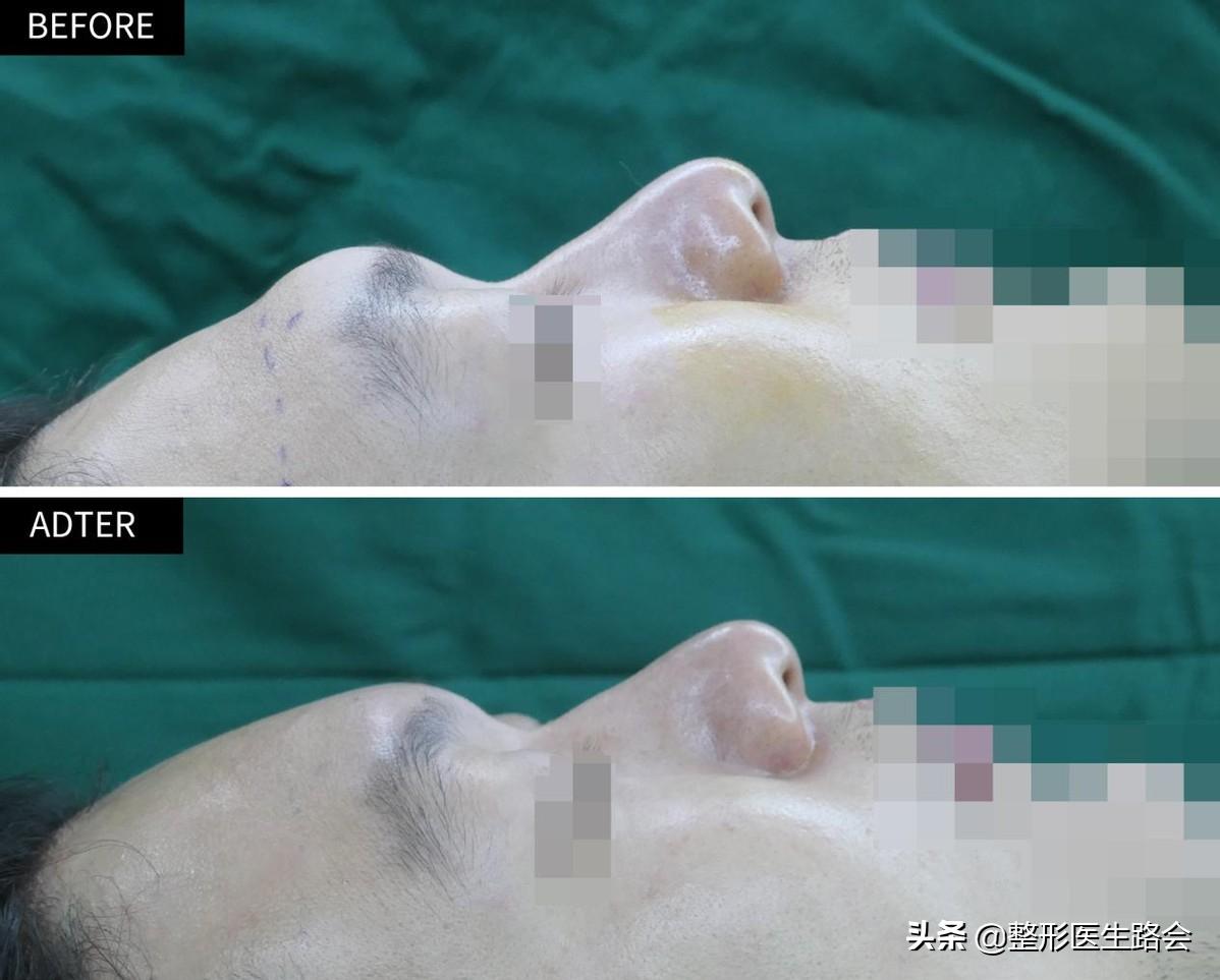 填充额头为什么额头有坑,填充额头过度饱满怎么消除