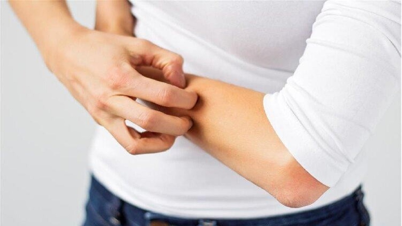 男性大量阴虱和虫卵,男子腹部痒