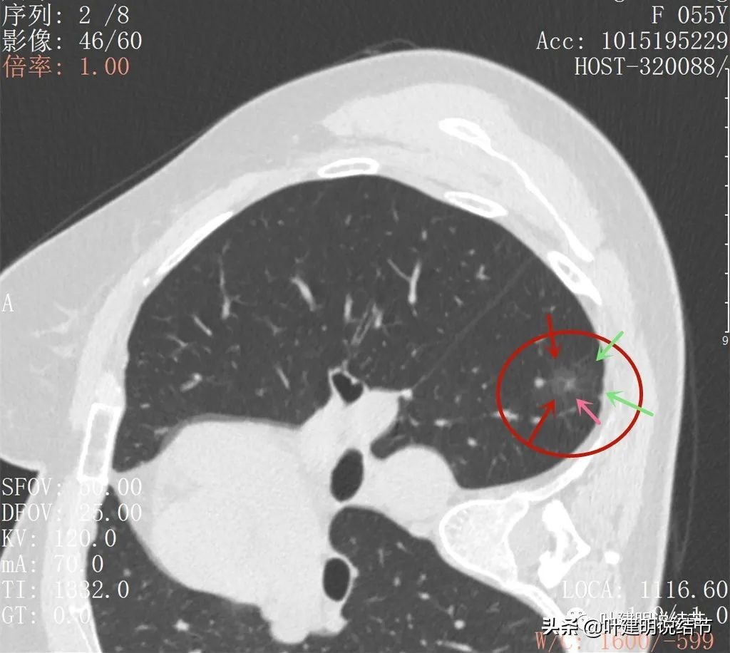 病例分享：这种样子的错构瘤？我是第一次见