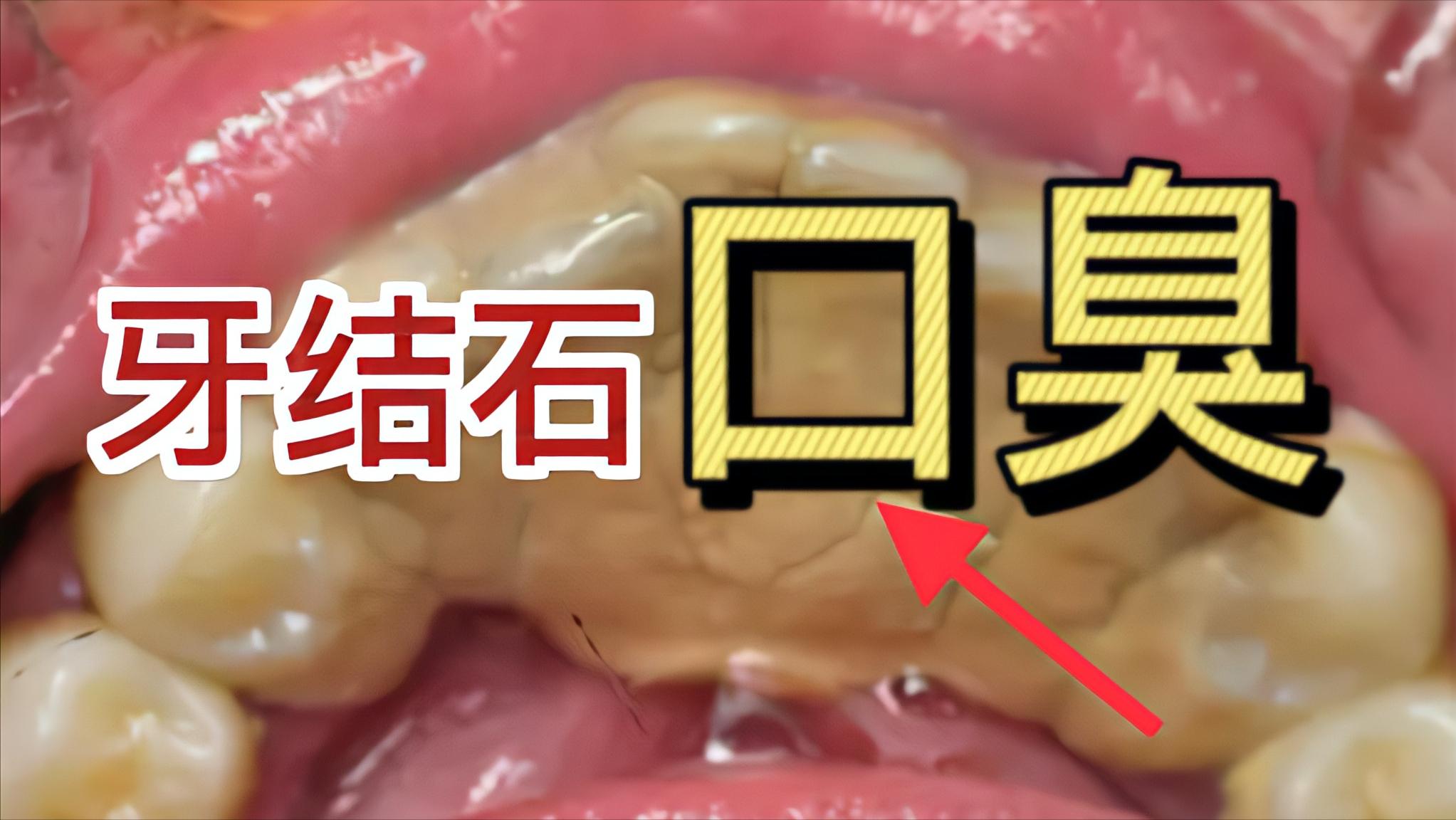 耗时半年，臭味熏天的牙结石口臭在家就根除！方法简单不要错过！