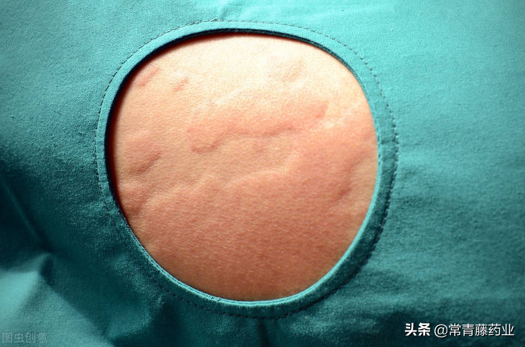 天气好转了寒冷性荨麻疹会自愈么,天气变冷荨麻疹中医病因分析