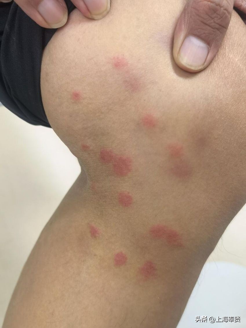 夏天虫咬皮炎的治疗方法,虫咬性皮炎到底如何杀虫