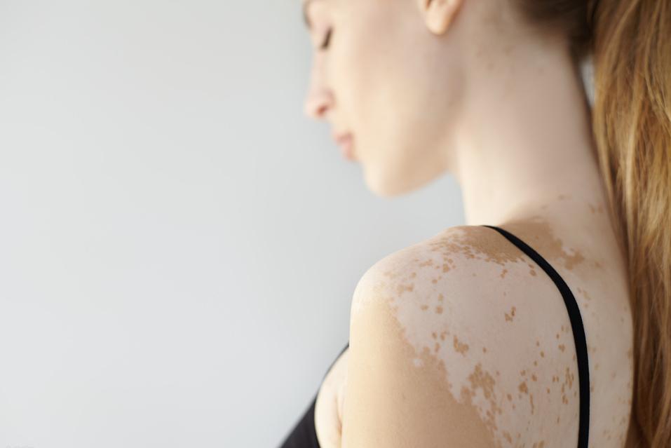 稳定期的白斑怎样快速复色,白斑复色成功