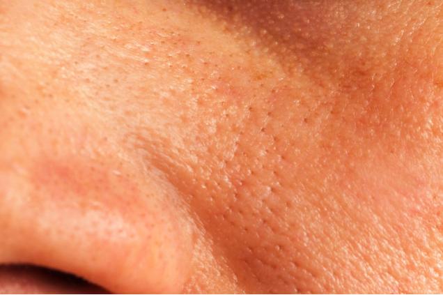 医生解决毛孔粗大小妙招快速有效,毛孔粗大难改变用好这三招全不见