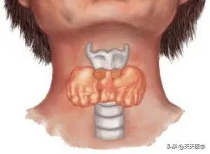 亚急性甲状腺炎的病因、诊断及治疗方法