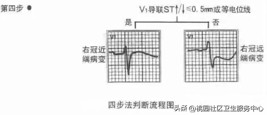 后循环梗死的识别,梗死分为哪三大类型