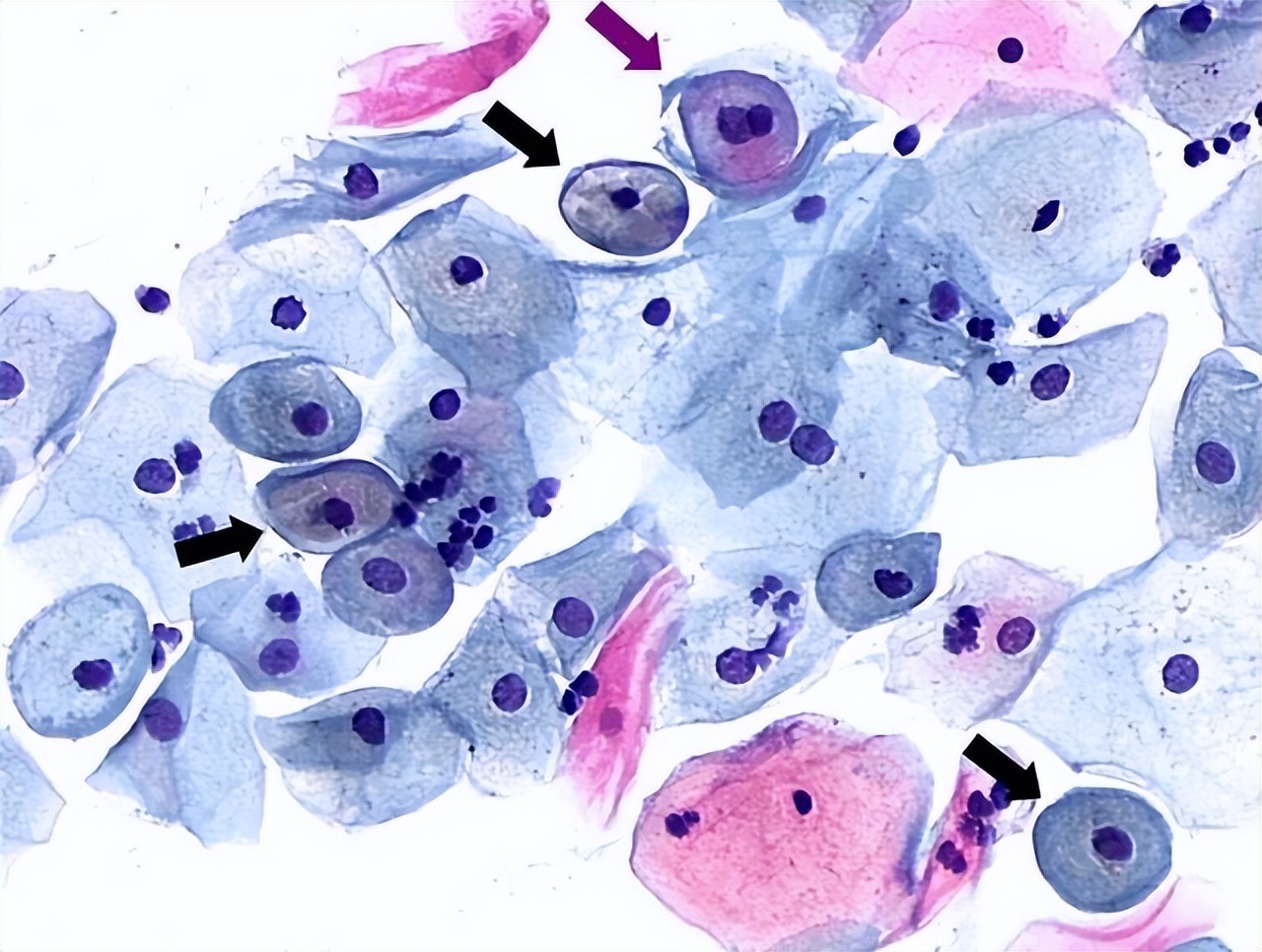 tct轻度炎症医生建议用干扰素,tct提示轻度炎症是宫颈息肉嘛