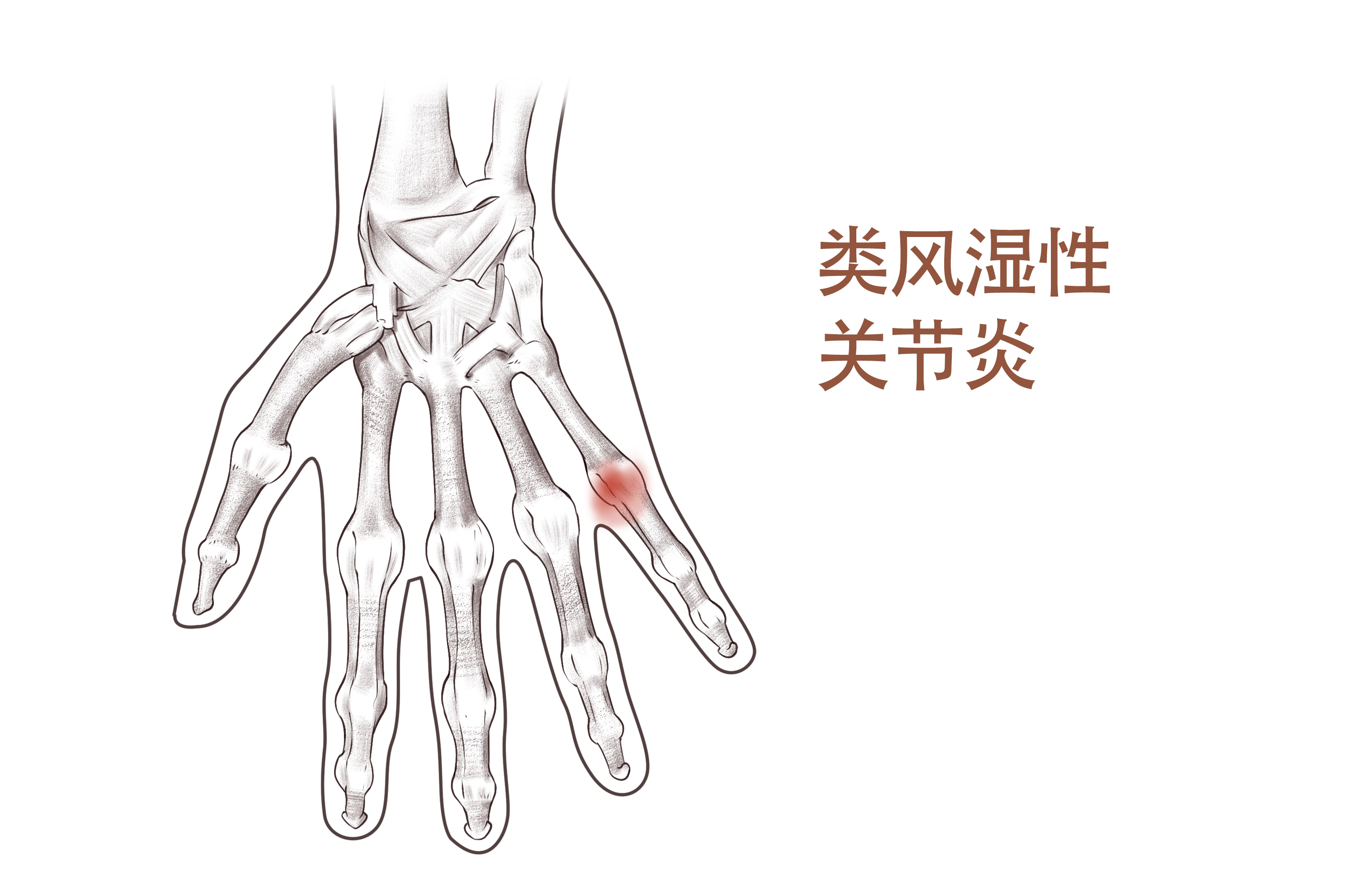 有什么治类风湿痛的好方法,类风湿关节疼痛快速解决最好办法